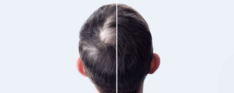 Vergleich Haarausfall und volles Haar nach der Eigenbluttherapie